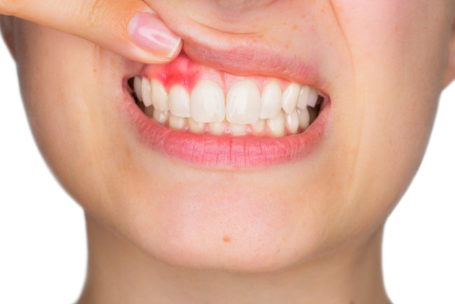 10 Basic Dental Care Tips to Save Your Gums